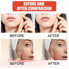 Load image into Gallery viewer, 144pcs/set Face Skin Care Acne Pimple Patch 2 Sizes Invisible Professional Healing Absorbing Spot Sticker Covering for Men Women